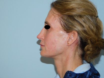 Mini Facelift Before & After Patient #3630