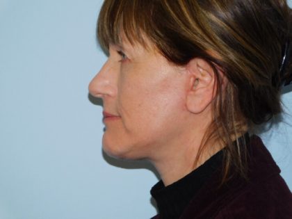 Traditional Facelift Before & After Patient #3703