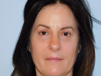 Blepharoplasty Before & After Patient #3664